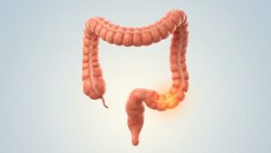 come capire se è colon irritabile